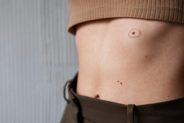 Birthmark on Stomach Meaning: 7 Important Messages